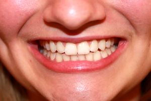 یک شرکت ژاپنی در مسیر تولید اولین دارو برای رویش دندان جدید