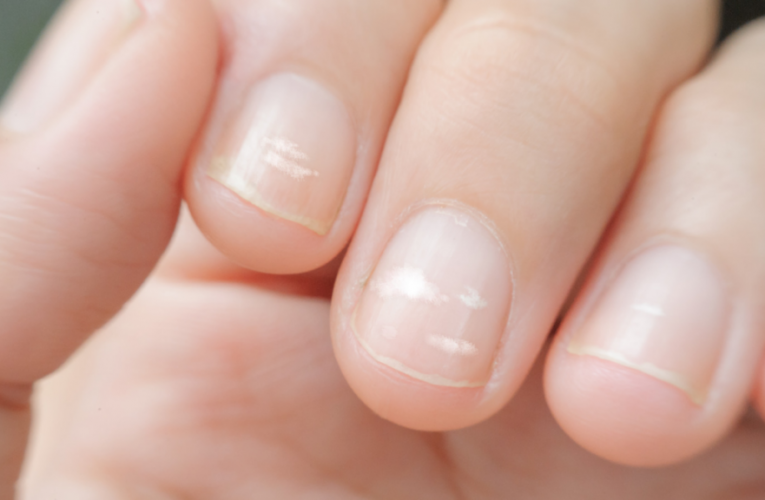 آیا می‌ دانید که علت به وجود آمدن لکه‌ های سفید روی ناخن چیست