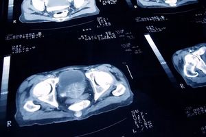 تعداد جلسات پرتودرمانی برای مردان مبتلا به سرطان پروستات را می‌توان کاهش داد