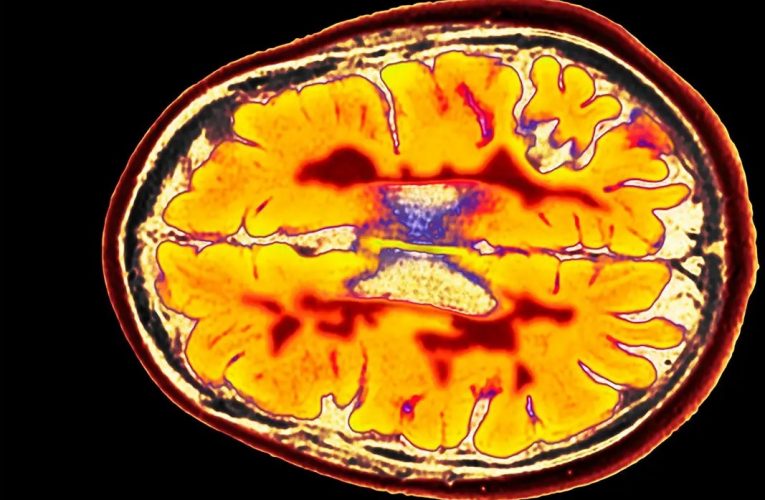 یک کشف مهم درباره MS ، نقش مهم باکتری هایی که میزبان حیوانی دارند در بروز بیماری