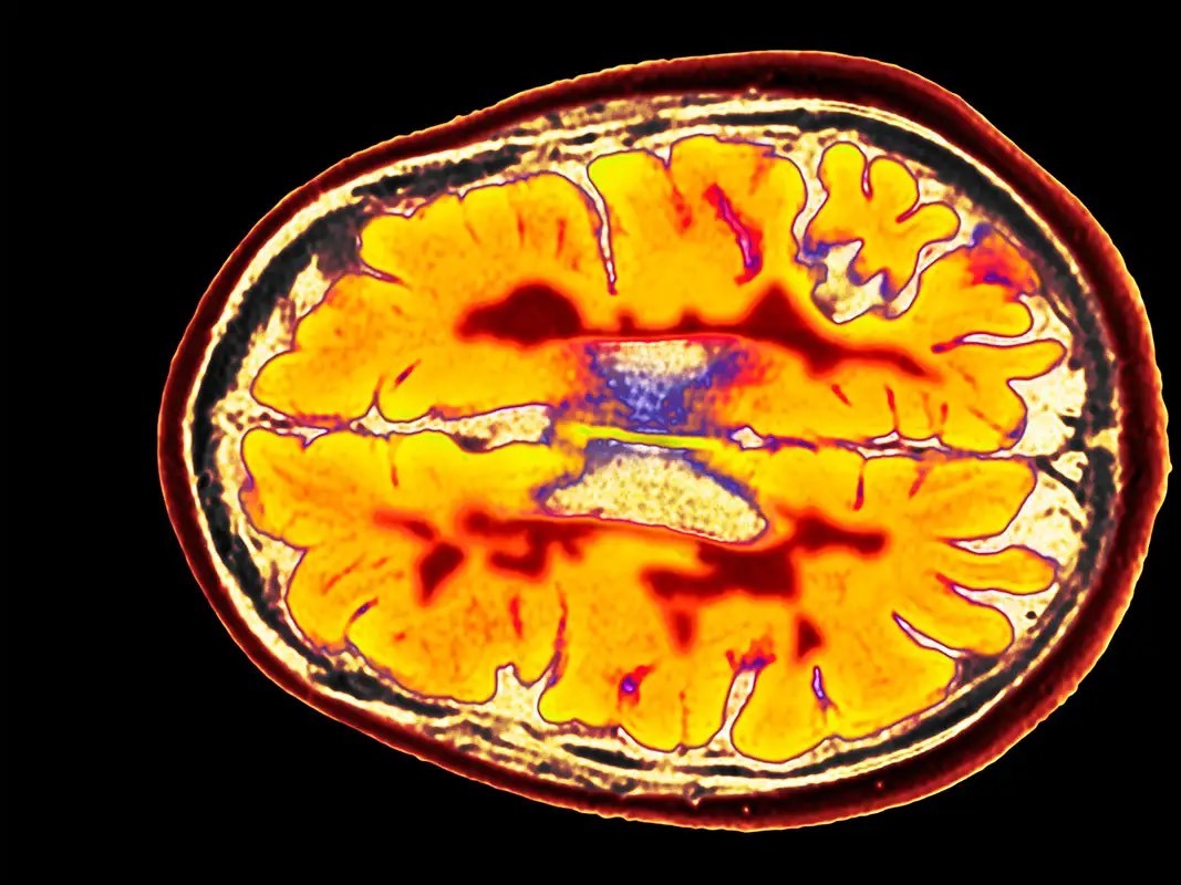 یک کشف مهم درباره MS ؛ نقش مهم باکتری هایی که میزبان حیوانی دارند در بروز بیماری!