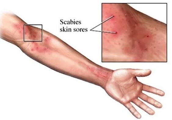 شیوع یک بیماری مُسری در انگلیس؛ متخصصان نگران کمبود دارو هستند