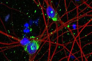 امید به درمان آلزایمر با مدل‌سازی تازه از نورون انسان_آینده