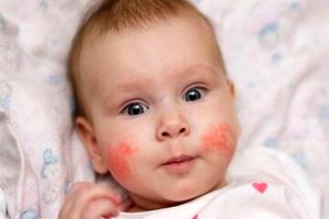 بلایی که افتاین ویتامین سر پوست کودکان می‌آورد_آینده