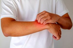 چطور بیماری اِگزِما را مدیریت کنیم؟_آینده