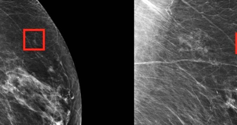 هوش مصنوعی و اثری باورنکردنی در تشخیص سرطان سینه_آینده