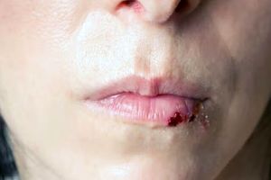 درمان موثر صدمه‌های لب‌ با پشتیبانی یک مدل سه‌بعدی_آینده