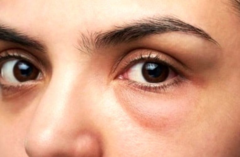 پف زیر چشم و درمان آن_آینده