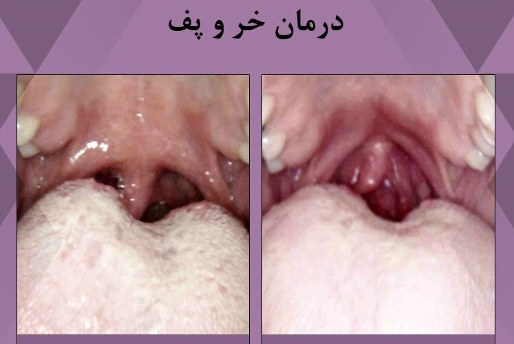 درمان قطعی خروپف در خواب
