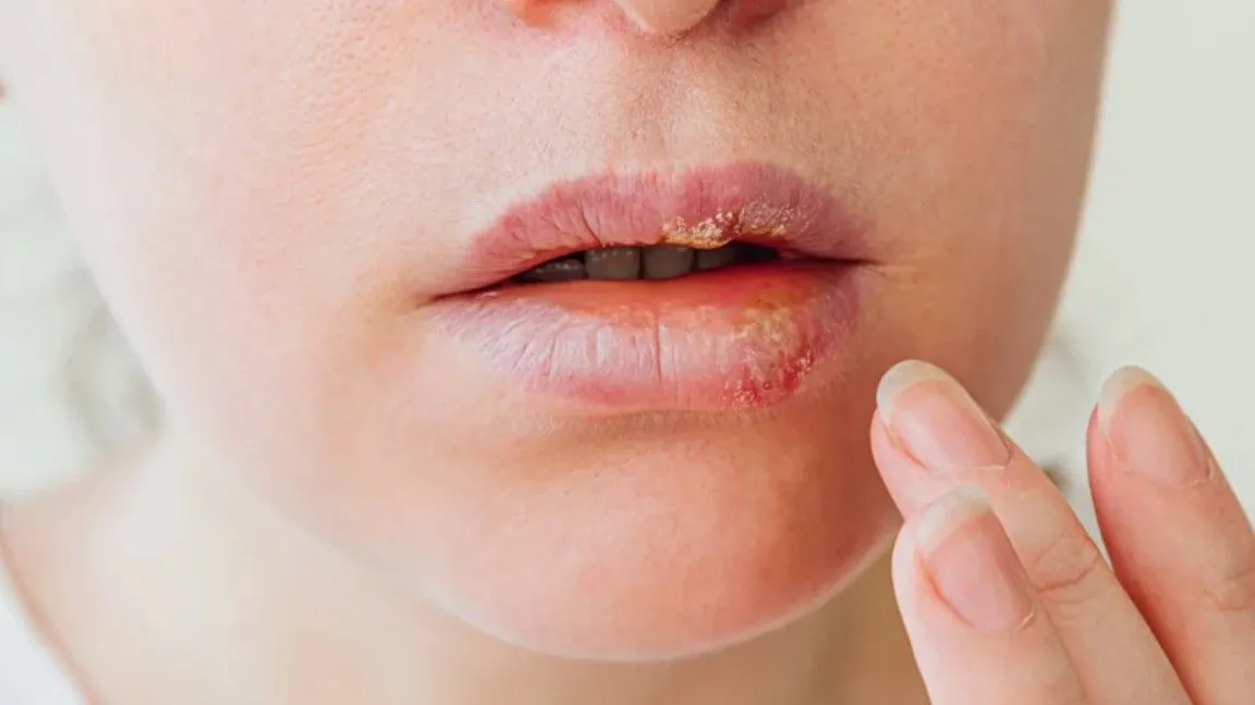 تبخال زدن احتمال آلزایمر را تقویت می‌کند