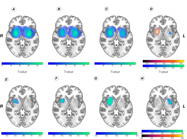 رابطه جدا گانه لرزش در بیماری پارکینسون با کارکرد دوپامین در مغز_آینده
