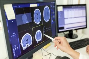 اوتیسم و ​​صرع مسیر مغزی مشترکی دارند