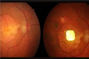 نابینایان با این ایمپلنت مجدد می‌توانند بخوانند_آینده