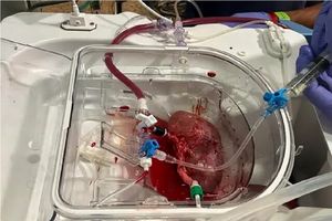 پیوند اولین کلیه هیبریدی انسان-خوک در اسپانیا