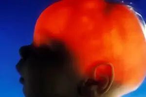 نوزادی که تقریباً بدون مغز متولد شد، ۲۰ سالگی‌اش را جشن گرفت