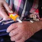 غرامت ۶۳۲ بیمار پروانهای واریز شد؛ پیگیری حقوق باقیمانده ادامه دارد